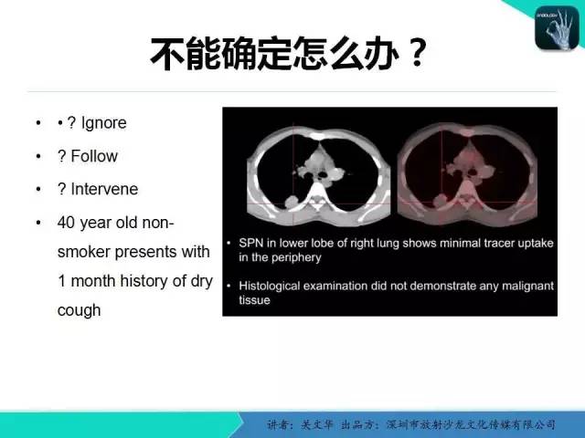 【PPT】孤立性肺结节的影像学诊断