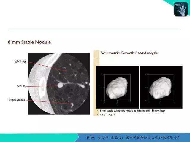 【PPT】孤立性肺结节的影像学诊断