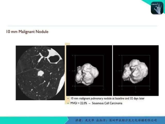 【PPT】孤立性肺结节的影像学诊断