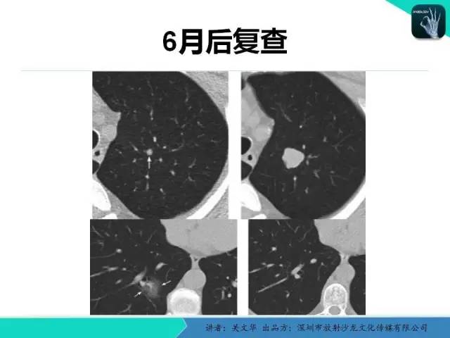 【PPT】孤立性肺结节的影像学诊断