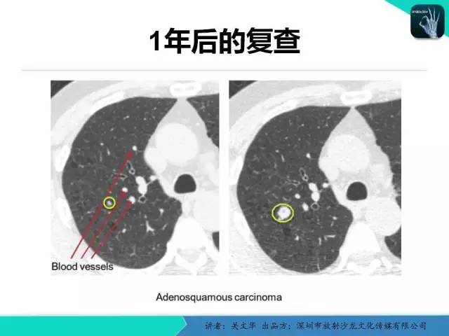 【PPT】孤立性肺结节的影像学诊断