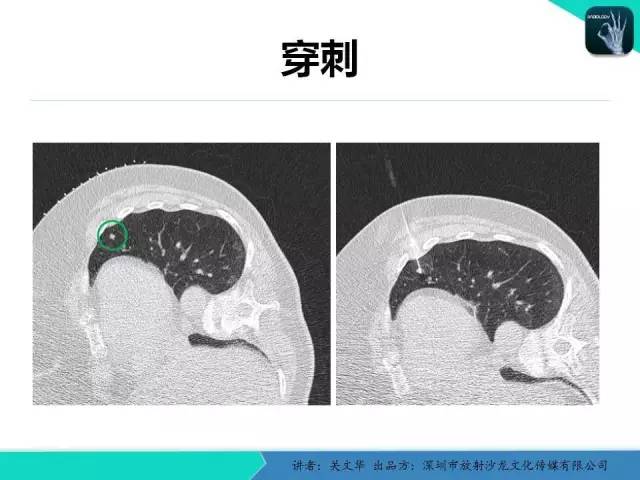 【PPT】孤立性肺结节的影像学诊断