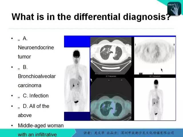 【PPT】孤立性肺结节的影像学诊断