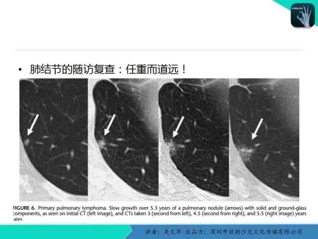 【PPT】孤立性肺结节的影像学诊断