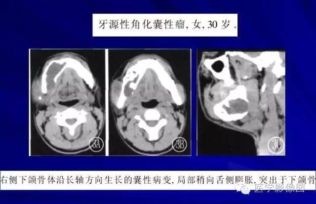 【PPT】常见颌骨囊肿与肿瘤的影像学表现