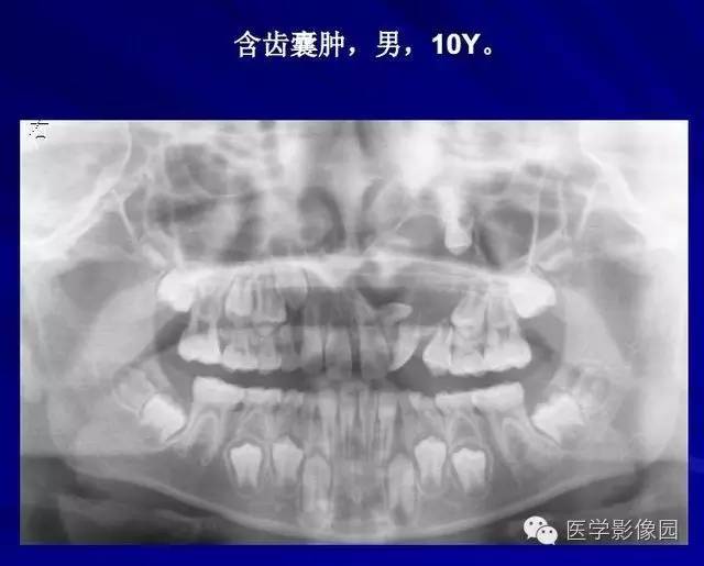 【PPT】常见颌骨囊肿与肿瘤的影像学表现
