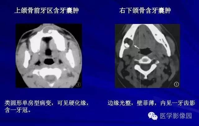 【PPT】常见颌骨囊肿与肿瘤的影像学表现