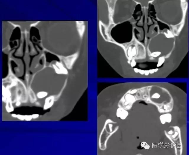 【PPT】常见颌骨囊肿与肿瘤的影像学表现