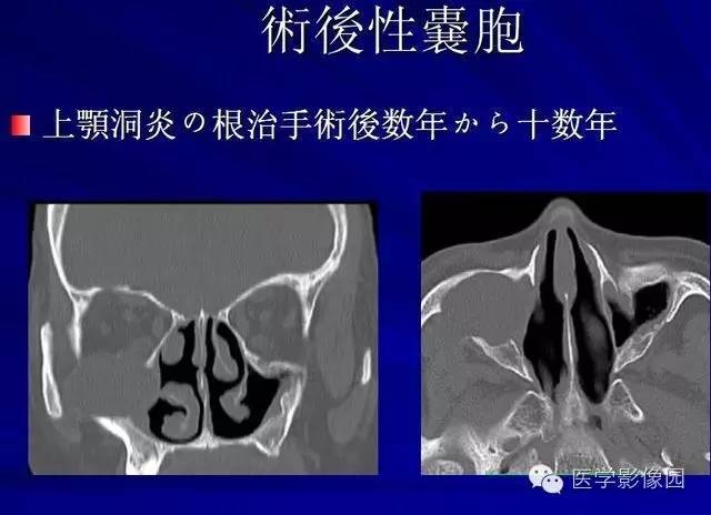 【PPT】常见颌骨囊肿与肿瘤的影像学表现