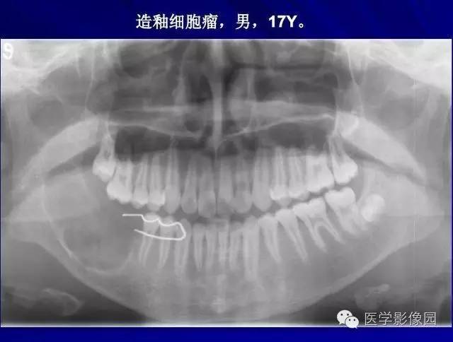 【PPT】常见颌骨囊肿与肿瘤的影像学表现
