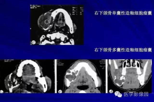 【PPT】常见颌骨囊肿与肿瘤的影像学表现