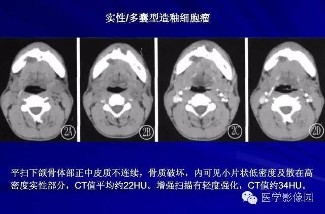 【PPT】常见颌骨囊肿与肿瘤的影像学表现