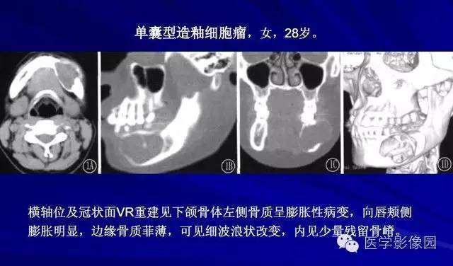 【PPT】常见颌骨囊肿与肿瘤的影像学表现