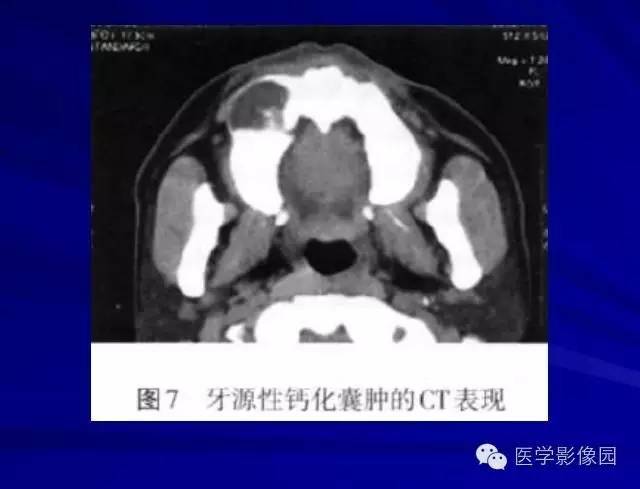 【PPT】常见颌骨囊肿与肿瘤的影像学表现
