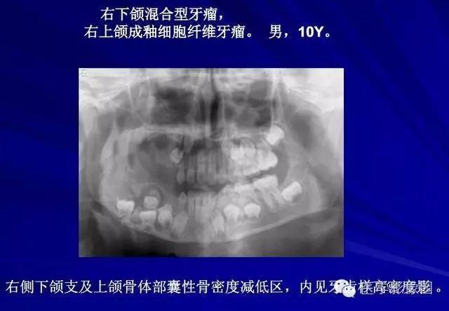 【PPT】常见颌骨囊肿与肿瘤的影像学表现