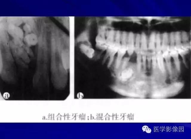 【PPT】常见颌骨囊肿与肿瘤的影像学表现