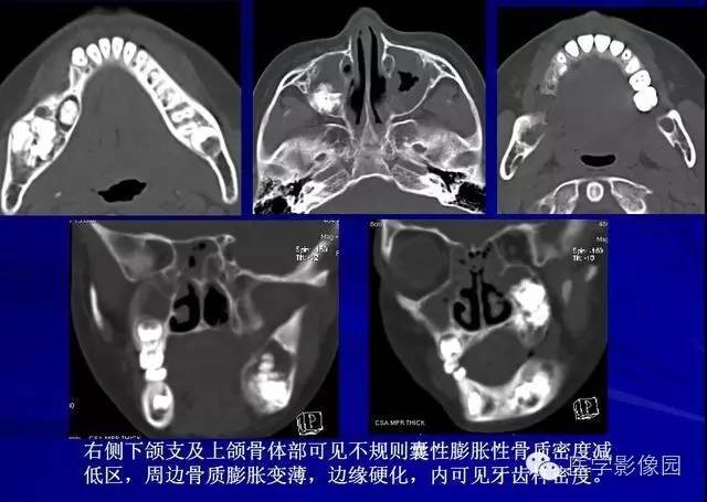 【PPT】常见颌骨囊肿与肿瘤的影像学表现