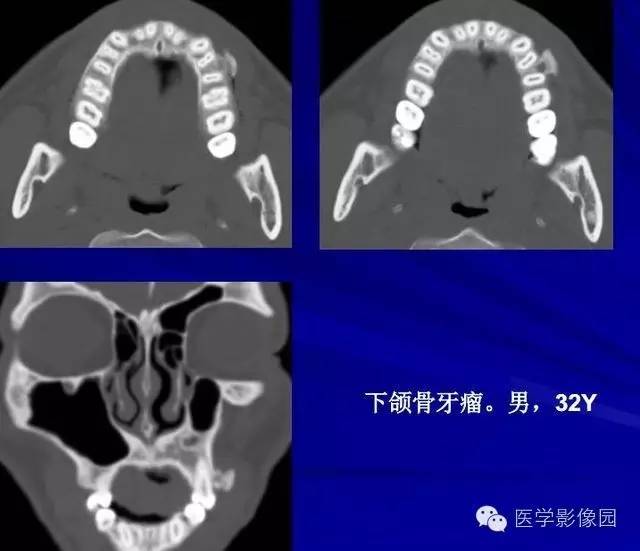 【PPT】常见颌骨囊肿与肿瘤的影像学表现