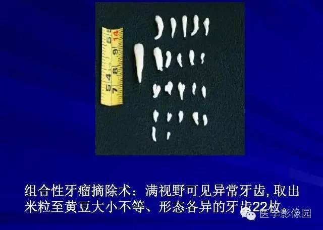【PPT】常见颌骨囊肿与肿瘤的影像学表现