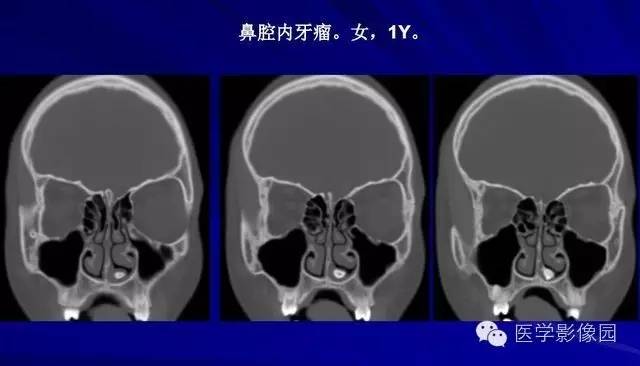 【PPT】常见颌骨囊肿与肿瘤的影像学表现