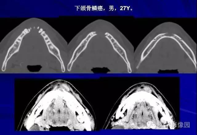 【PPT】常见颌骨囊肿与肿瘤的影像学表现