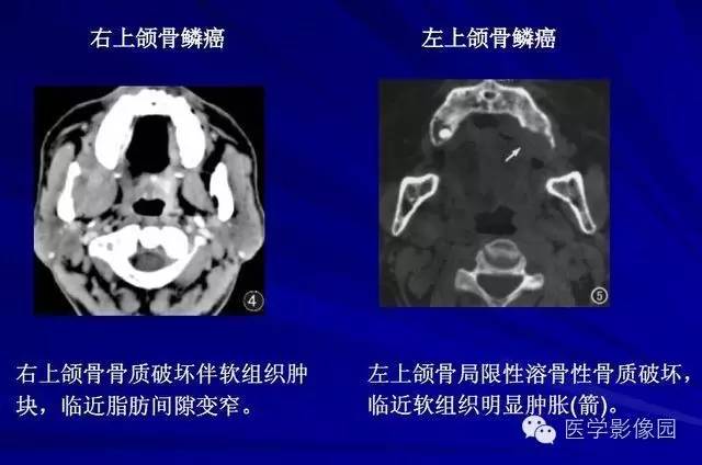【PPT】常见颌骨囊肿与肿瘤的影像学表现