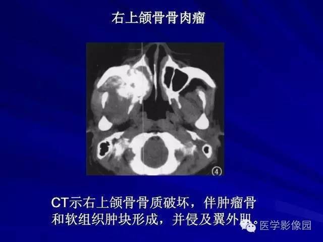 【PPT】常见颌骨囊肿与肿瘤的影像学表现