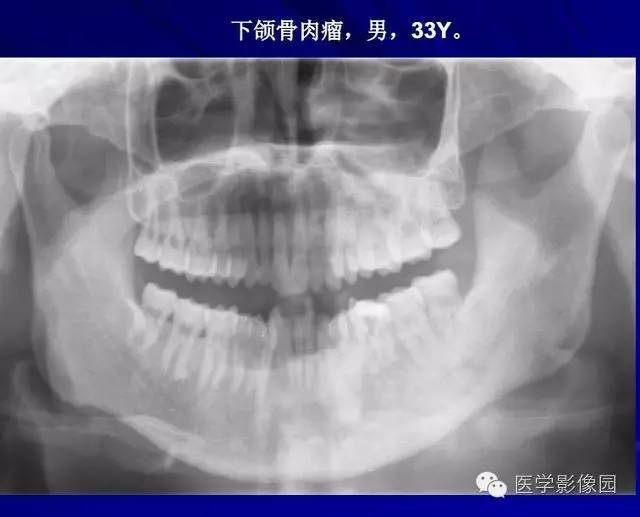 【PPT】常见颌骨囊肿与肿瘤的影像学表现