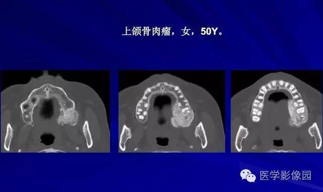 【PPT】常见颌骨囊肿与肿瘤的影像学表现