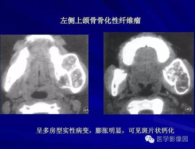 【PPT】常见颌骨囊肿与肿瘤的影像学表现