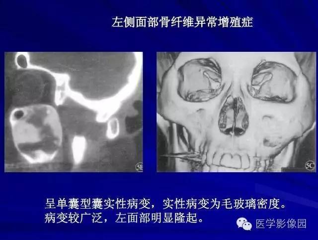 【PPT】常见颌骨囊肿与肿瘤的影像学表现