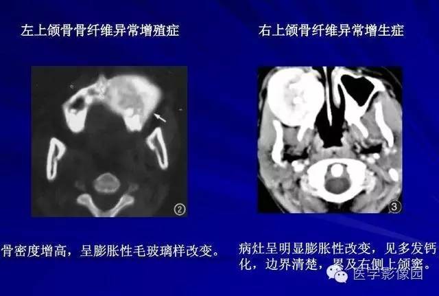 【PPT】常见颌骨囊肿与肿瘤的影像学表现