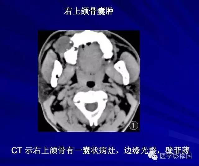 【PPT】常见颌骨囊肿与肿瘤的影像学表现