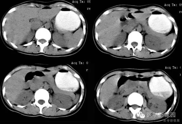 【病例】胰腺实性假乳头状瘤1例CT影像表现