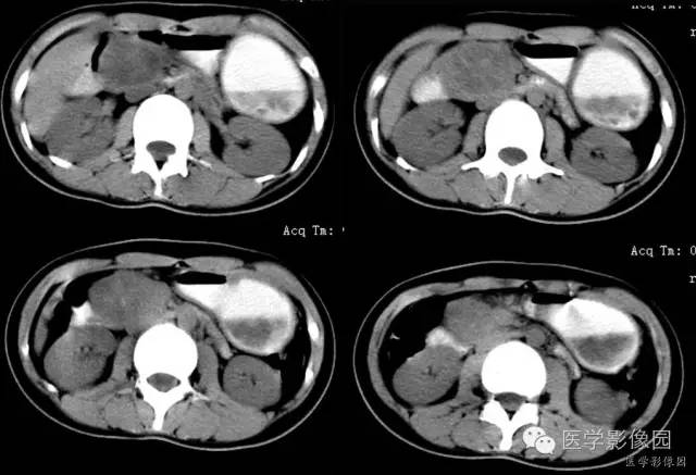 【病例】胰腺实性假乳头状瘤1例CT影像表现 【病例】胰腺实性假乳头状瘤1例CT影像表现