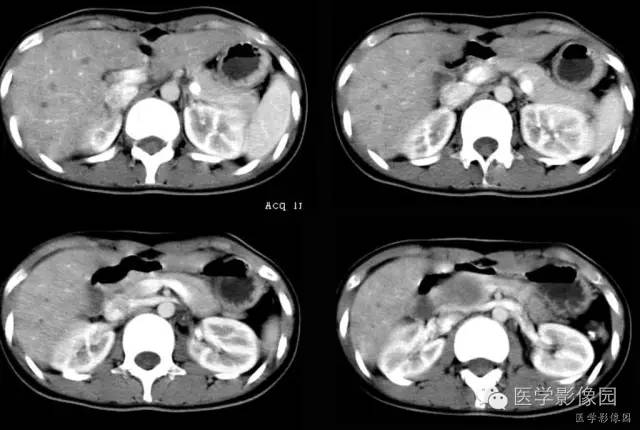 【病例】胰腺实性假乳头状瘤1例CT影像表现 【病例】胰腺实性假乳头状瘤1例CT影像表现