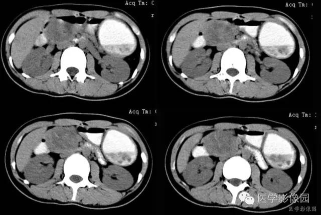 【病例】胰腺实性假乳头状瘤1例CT影像表现 【病例】胰腺实性假乳头状瘤1例CT影像表现