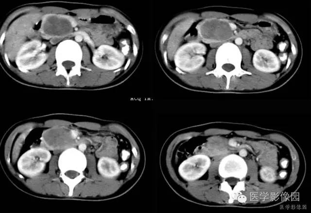 【病例】胰腺实性假乳头状瘤1例CT影像表现 【病例】胰腺实性假乳头状瘤1例CT影像表现