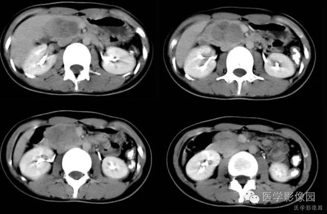 【病例】胰腺实性假乳头状瘤1例CT影像表现 【病例】胰腺实性假乳头状瘤1例CT影像表现