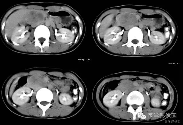 【病例】胰腺实性假乳头状瘤1例CT影像表现 【病例】胰腺实性假乳头状瘤1例CT影像表现