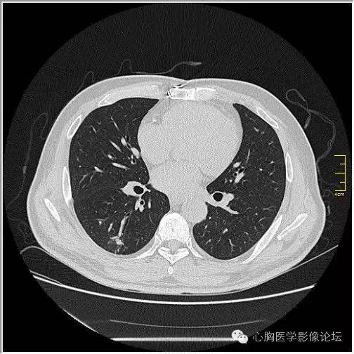 【病例】空腔型肺癌1例CT影像诊断与分析