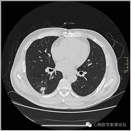 【病例】空腔型肺癌1例CT影像诊断与分析 【病例】空腔型肺癌1例CT影像诊断与分析