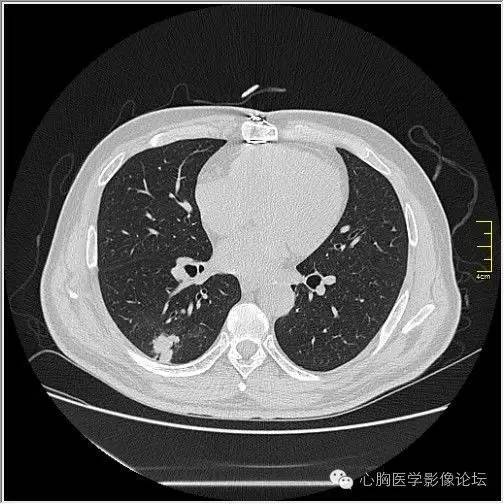 【病例】空腔型肺癌1例CT影像诊断与分析 【病例】空腔型肺癌1例CT影像诊断与分析