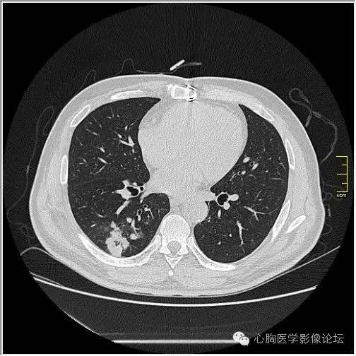 【病例】空腔型肺癌1例CT影像诊断与分析 【病例】空腔型肺癌1例CT影像诊断与分析