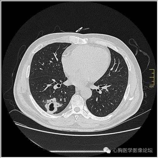 【病例】空腔型肺癌1例CT影像诊断与分析 【病例】空腔型肺癌1例CT影像诊断与分析