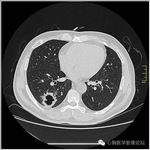 【病例】空腔型肺癌1例CT影像诊断与分析 【病例】空腔型肺癌1例CT影像诊断与分析