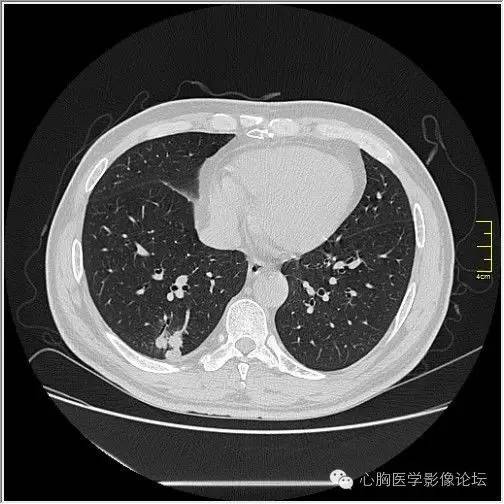 【病例】空腔型肺癌1例CT影像诊断与分析 【病例】空腔型肺癌1例CT影像诊断与分析