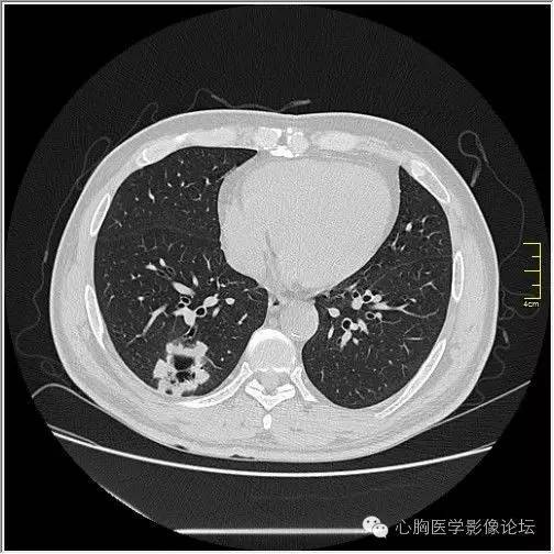 【病例】空腔型肺癌1例CT影像诊断与分析 【病例】空腔型肺癌1例CT影像诊断与分析