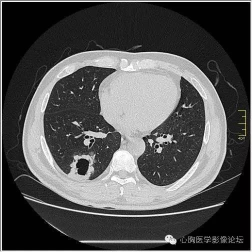 【病例】空腔型肺癌1例CT影像诊断与分析 【病例】空腔型肺癌1例CT影像诊断与分析