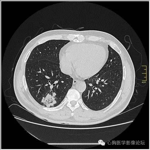【病例】空腔型肺癌1例CT影像诊断与分析 【病例】空腔型肺癌1例CT影像诊断与分析